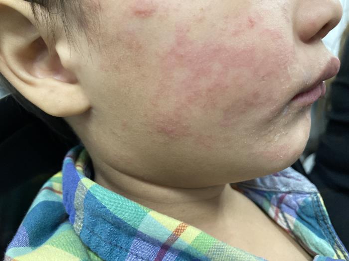 This photograph, taken in the United States depicts a child who was infected with the Morbillivirus, also known as measles, or rubeola during a domestic outbreak in 2024. The child’s cheek shows the characteristic rash associated with this viral infection.